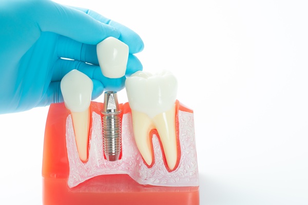 Implant Crowns: The Key To Restoring Missing Teeth