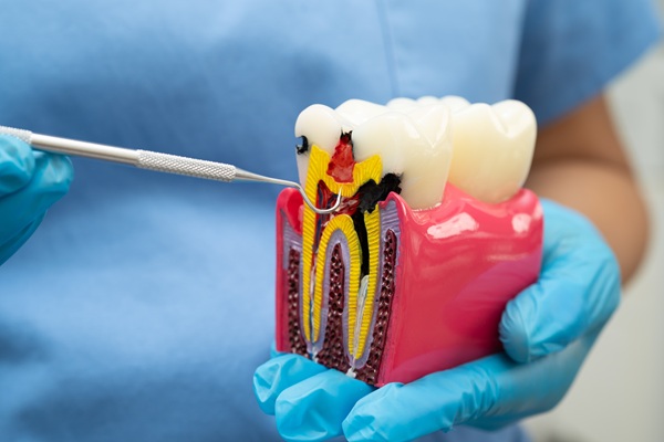 Can Root Canal Treatment Save Teeth?